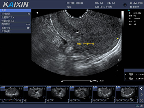 妇科B超机有哪些检查方式，能检查哪些疾病？