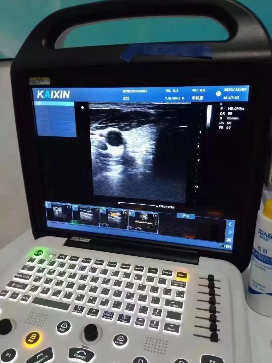 甲状腺结节的超声检查的临床表现